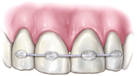 Splint placement after replanting an avulsed tooth