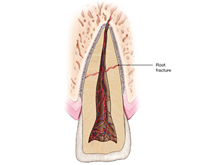 Tooth Abscess and Root Canals