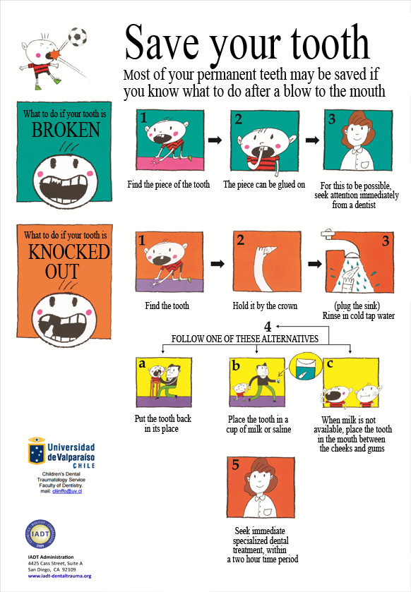 A Quick guide for responding to a dental trauma
