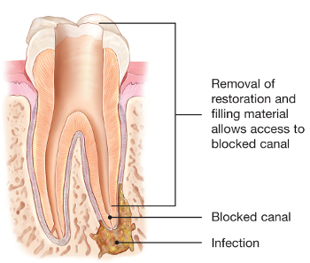 Removal of infected root canal material
