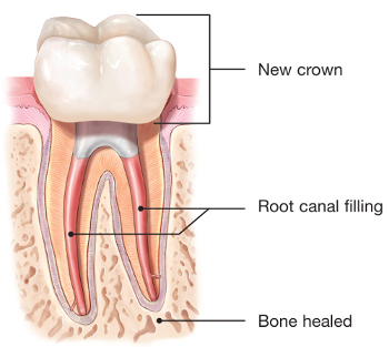 Root canal retreated tooth with a final crown