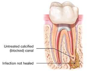 Re-infected root canal treatment