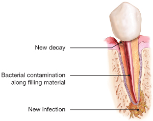 Decay causing root canal re-infection