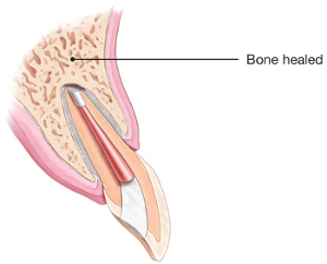 Healed bone cavity after apicoectomy