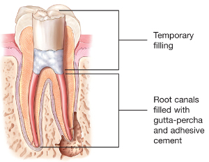 A Root Canal Tooth with Temporary Access Restoration