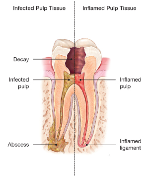 Abscess formation in a permanent mandibular molar