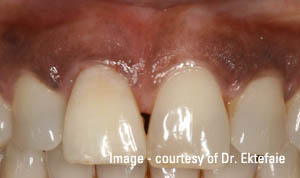 Tooth whitened by internal bleaching technique by an endodontist