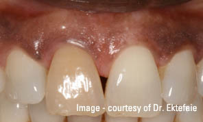 Tooth injury resulted in brown discoloration